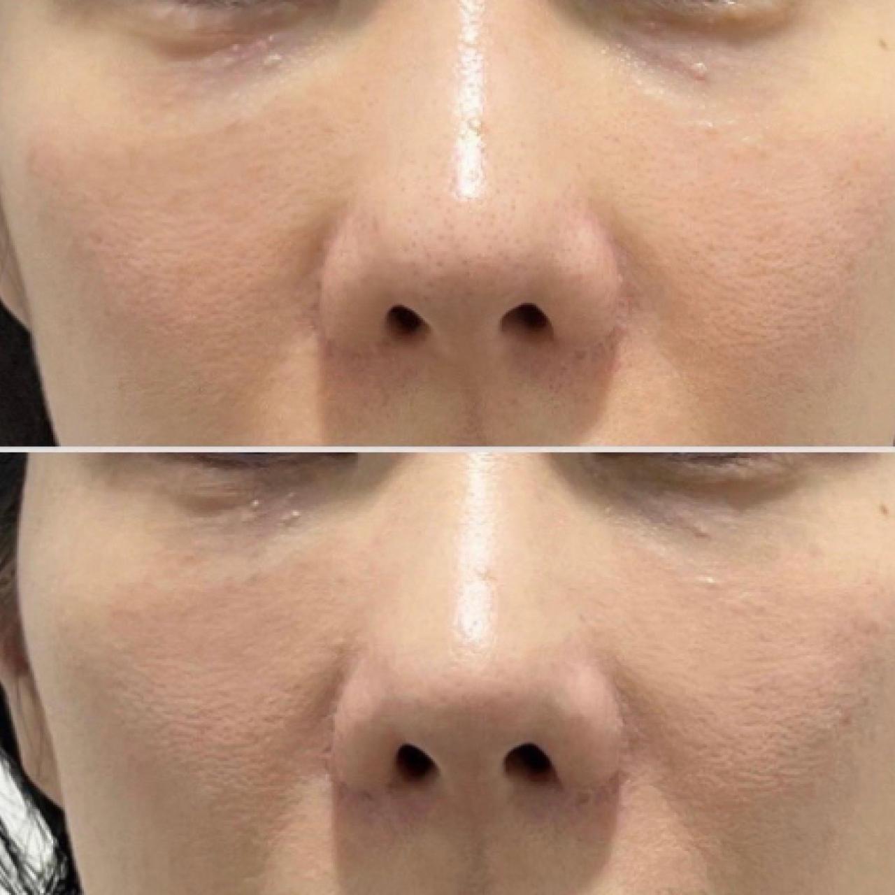 울트라콜 눈밑 1차