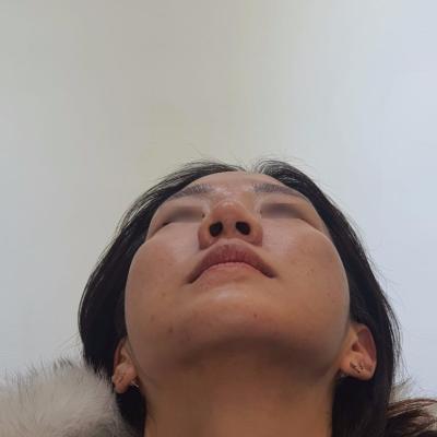 테스코 리프팅 , 코 실리프팅, 강남역 테스코, 정품, 아이필유의원 강남 , 테스코 전후 사진