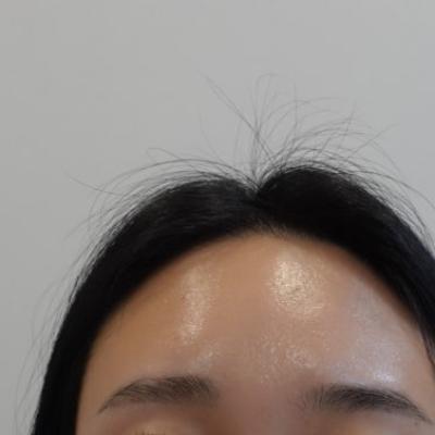 아이필유 시그니처 이마필러 시술 [출처] 아이필유 시그니처 이마필러 시술|작성자 닥터벨라