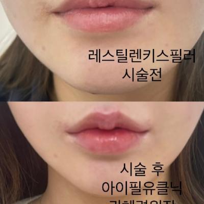 프리미엄 레스틸렌 키스 입술필러 시술 전 후