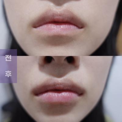 입꼬리필러, 아랫입술볼륨필러 전후사진 , 입술전용 레스틸렌키스필러 가격