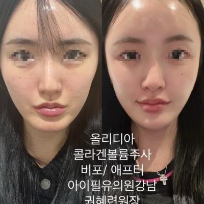 올리디아 옆볼 콜라겐 볼륨주사 시술 전 후, 해골상, 얼굴라인 만들기